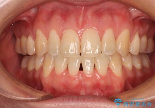 膨らんだ口元をスッキリと ワイヤー装置での抜歯矯正の症例 治療後