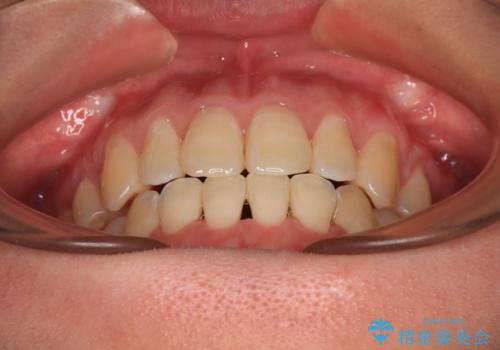 膨らんだ口元をスッキリと ワイヤー装置での抜歯矯正の治療後
