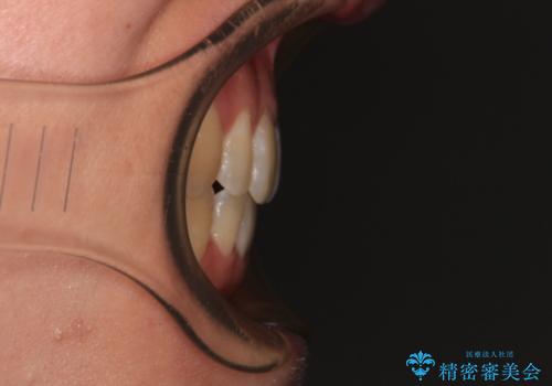 膨らんだ口元をスッキリと ワイヤー装置での抜歯矯正の治療後