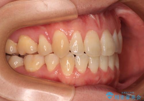 膨らんだ口元をスッキリと ワイヤー装置での抜歯矯正の治療後