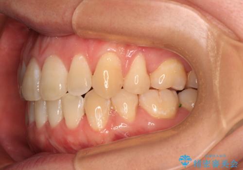 膨らんだ口元をスッキリと ワイヤー装置での抜歯矯正の治療後