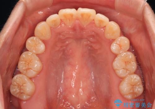 膨らんだ口元をスッキリと ワイヤー装置での抜歯矯正の治療後