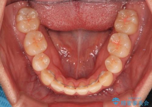 膨らんだ口元をスッキリと ワイヤー装置での抜歯矯正の治療後