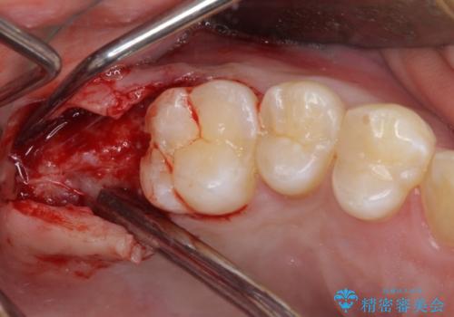 抜歯が必要な奥歯と前歯のデコボコ　インプラント治療とインビザライン矯正治療の治療中