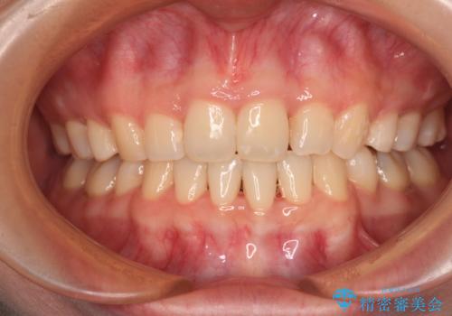 抜歯矯正へ切り替え　表側のワイヤー矯正の症例 治療後