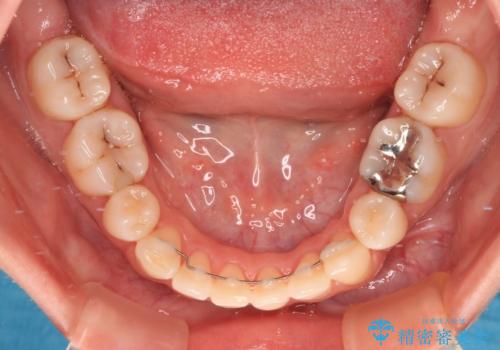 抜歯矯正へ切り替え　表側のワイヤー矯正の治療後