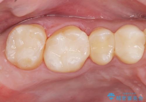 銀の詰め物をやりかえたいの症例 治療後