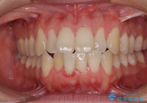 膨らんだ口元をスッキリと ワイヤー装置での抜歯矯正の症例 治療前