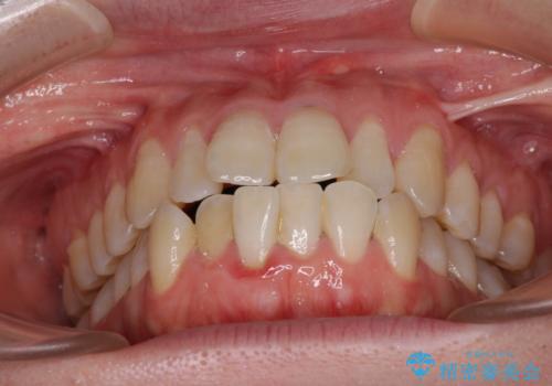 膨らんだ口元をスッキリと ワイヤー装置での抜歯矯正の治療前