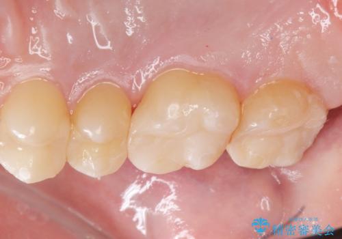 銀の詰め物をやりかえたいの治療後