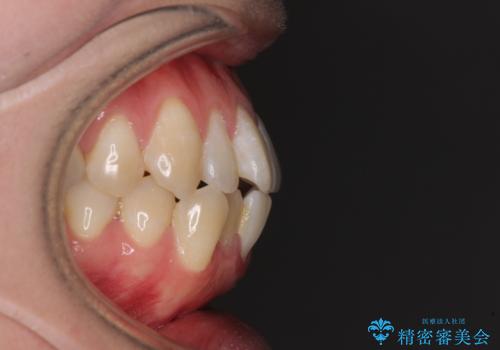 膨らんだ口元をスッキリと ワイヤー装置での抜歯矯正の治療前