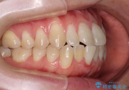 膨らんだ口元をスッキリと ワイヤー装置での抜歯矯正の治療前