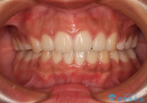 口が閉じられない　抜歯矯正で横顔の印象が劇的に変化の症例 治療後