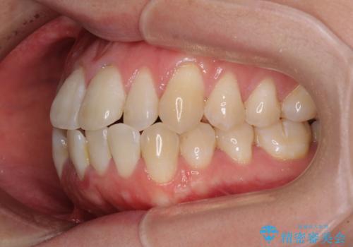 膨らんだ口元をスッキリと ワイヤー装置での抜歯矯正の治療前