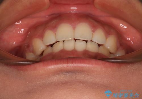 口が閉じられない 抜歯矯正で横顔の印象が劇的に変化の治療後