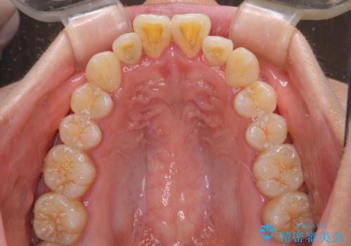 膨らんだ口元をスッキリと ワイヤー装置での抜歯矯正の治療前