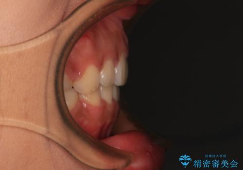 口が閉じられない　抜歯矯正で横顔の印象が劇的に変化の治療後