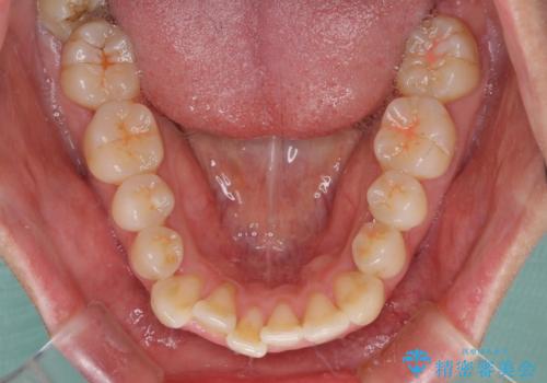 膨らんだ口元をスッキリと ワイヤー装置での抜歯矯正の治療前