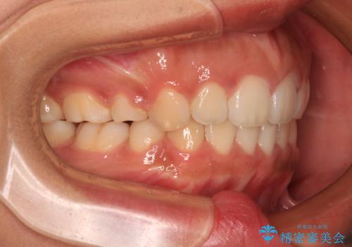 口が閉じられない 抜歯矯正で横顔の印象が劇的に変化の治療後