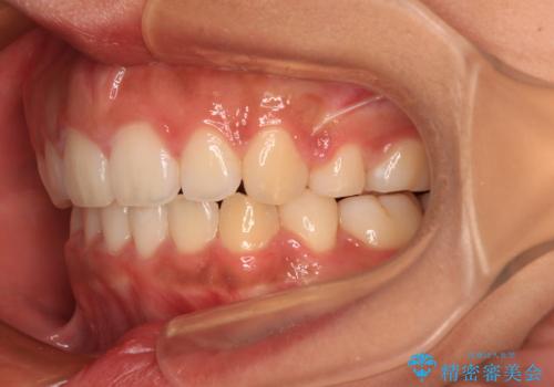 口が閉じられない　抜歯矯正で横顔の印象が劇的に変化の治療後