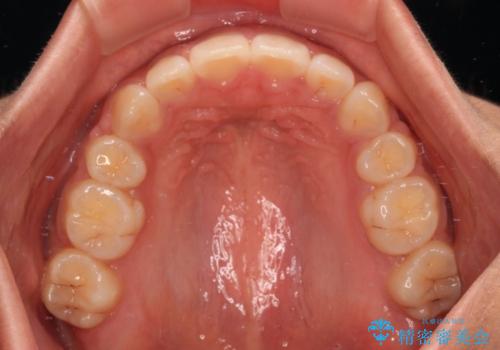 口が閉じられない 抜歯矯正で横顔の印象が劇的に変化の治療後
