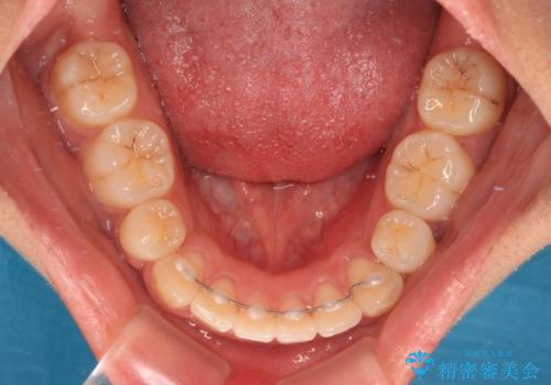 口が閉じられない 抜歯矯正で横顔の印象が劇的に変化の治療後