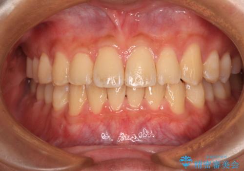 抜歯が必要な奥歯と前歯のデコボコ　インプラント治療とインビザライン矯正治療