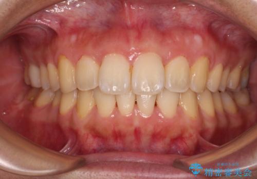 前に出ている前歯を引っ込めたい インビザライン矯正の症例 治療後