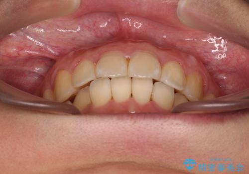 前に出ている前歯を引っ込めたい インビザライン矯正の治療後