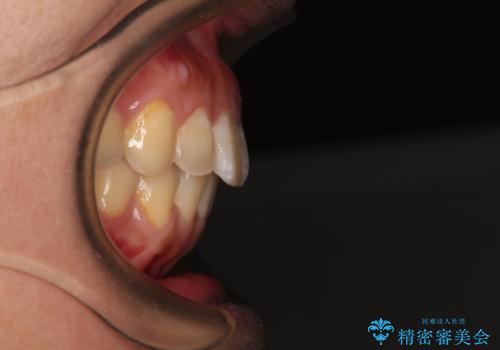 前に出ている前歯を引っ込めたい インビザライン矯正の治療後