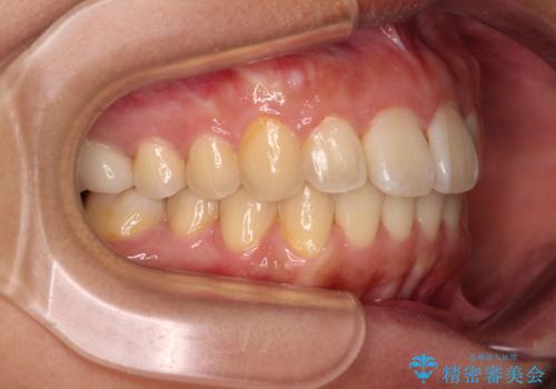 前に出ている前歯を引っ込めたい インビザライン矯正の治療後