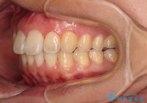 前に出ている前歯を引っ込めたい インビザライン矯正の治療後