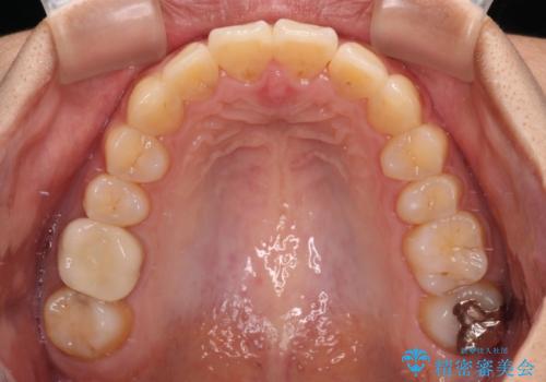 前に出ている前歯を引っ込めたい インビザライン矯正の治療後