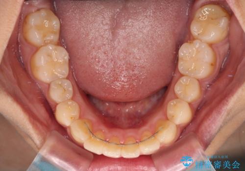 前に出ている前歯を引っ込めたい インビザライン矯正の治療後