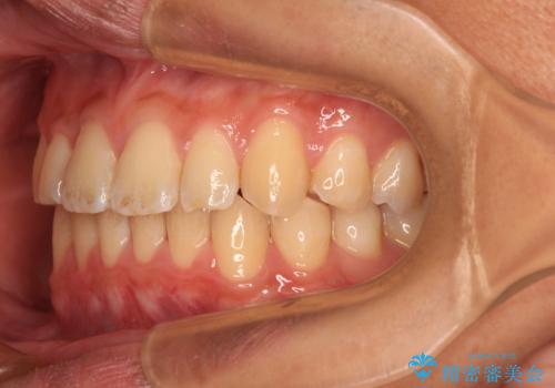 抜歯が必要な奥歯と前歯のデコボコ　インプラント治療とインビザライン矯正治療の治療後