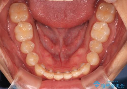 抜歯が必要な奥歯と前歯のデコボコ　インプラント治療とインビザライン矯正治療の治療後