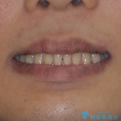 抜歯が必要な奥歯と前歯のデコボコ　インプラント治療とインビザライン矯正治療の治療後（顔貌）