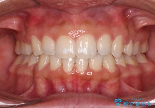 閉じにくい唇 抜歯矯正でスッキリした横顔にの治療後