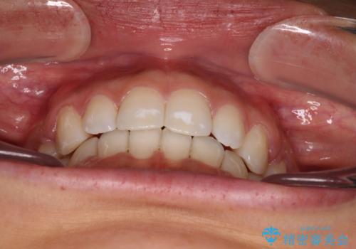 閉じにくい唇 抜歯矯正でスッキリした横顔にの治療後
