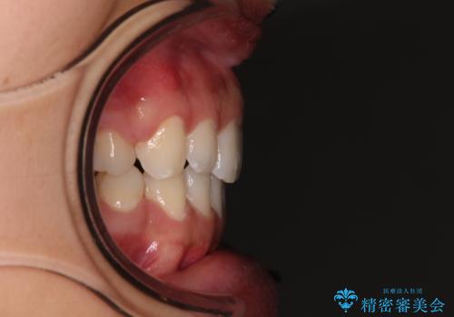 閉じにくい唇 抜歯矯正でスッキリした横顔にの治療後