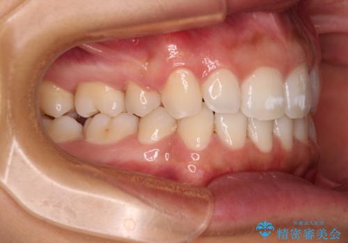 閉じにくい唇 抜歯矯正でスッキリした横顔にの治療後