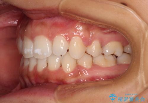 閉じにくい唇 抜歯矯正でスッキリした横顔にの治療後