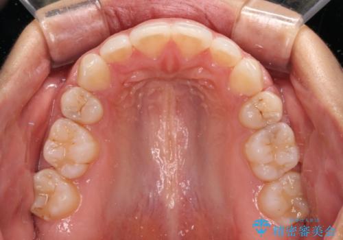 閉じにくい唇 抜歯矯正でスッキリした横顔にの治療後