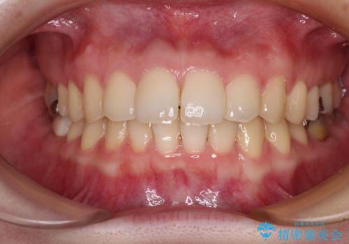 デコボコ歯列をきれいに インビザラインによる矯正治療の治療中