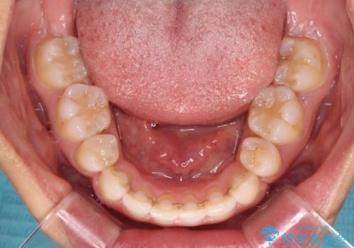 閉じにくい唇 抜歯矯正でスッキリした横顔にの治療後