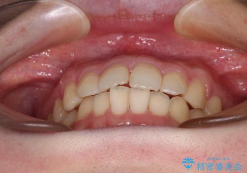 デコボコ歯列をきれいに インビザラインによる矯正治療の治療中