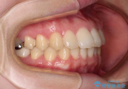 デコボコ歯列をきれいに インビザラインによる矯正治療の治療中