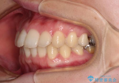 デコボコ歯列をきれいに インビザラインによる矯正治療の治療中