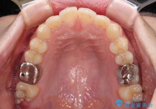 デコボコ歯列をきれいに インビザラインによる矯正治療の治療中