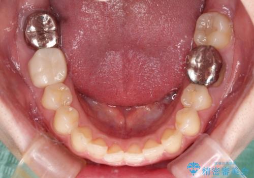 デコボコ歯列をきれいに インビザラインによる矯正治療の治療中